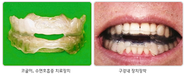  코골이 클리닉/수면 무호흡증
