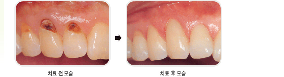  보존 보철