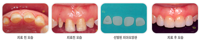  심미보철