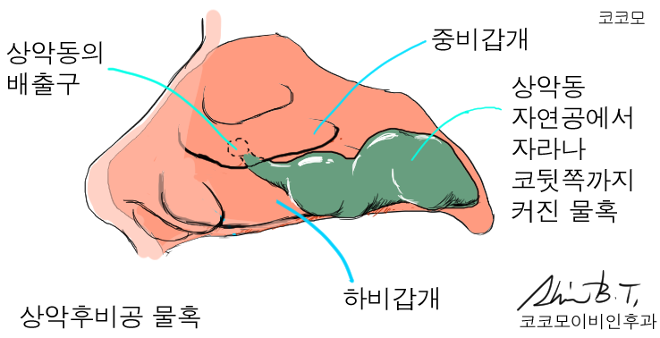  코물혹수술과 축농증수술로 해결된 한쪽 코막힘과 만성 두통, 그리고 후비루
