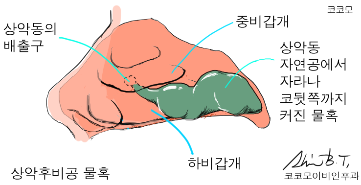 코물혹수술과 축농증수술로 해결된 한쪽 코막힘과 만성 두통, 그리고 후비루