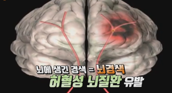 뇌졸중에 좋은 승모근운동과 침향의 효능