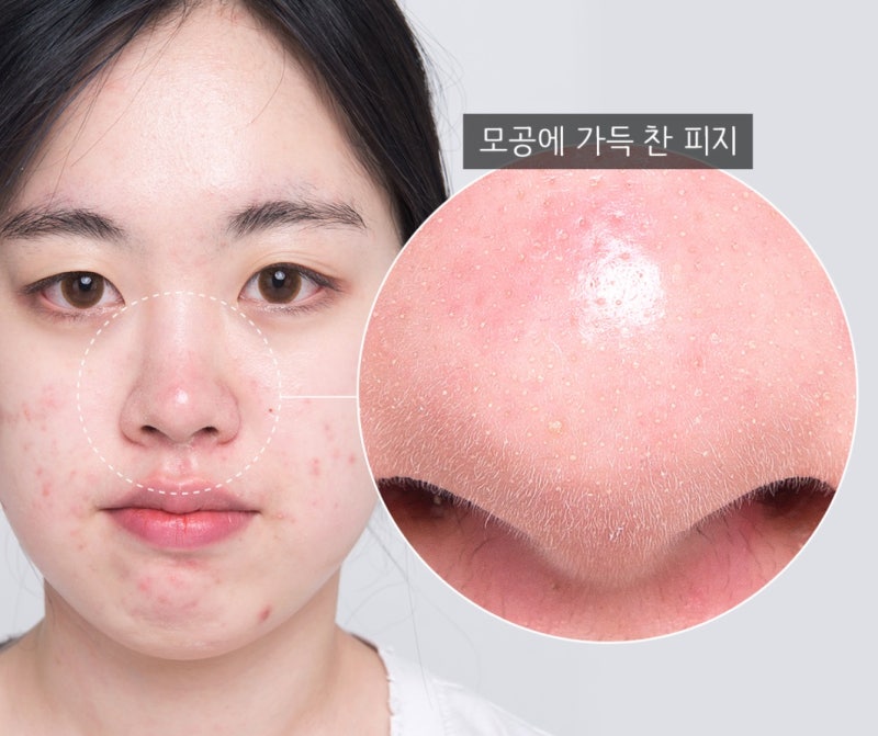 여름에 각질 제거 후 미백 피부를 유지하는 방법은 무엇입니까?
