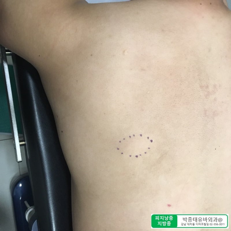 [Dr.ParK] 등 깊숙한 곳에서 혹이 만져집니다. 근막에 둘러싸인 지방종 제거 수술 4
