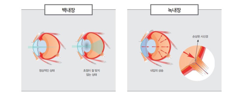 녹내장 백내장과 비슷한 형태로