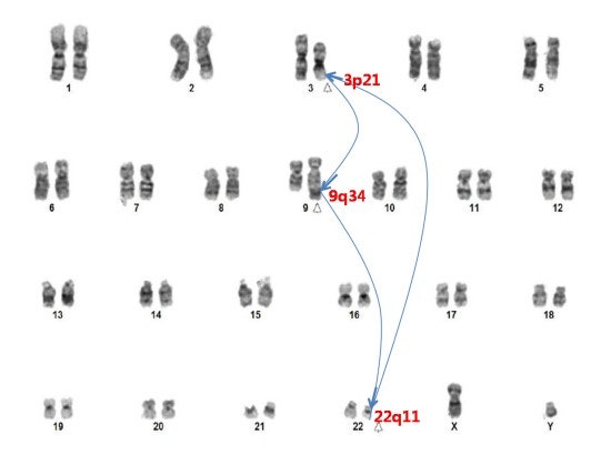 필라델피아 염색체(Philadelphia chromosome, Ph) 발전사 : 네이버 블로그
