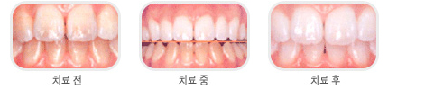  미백치료