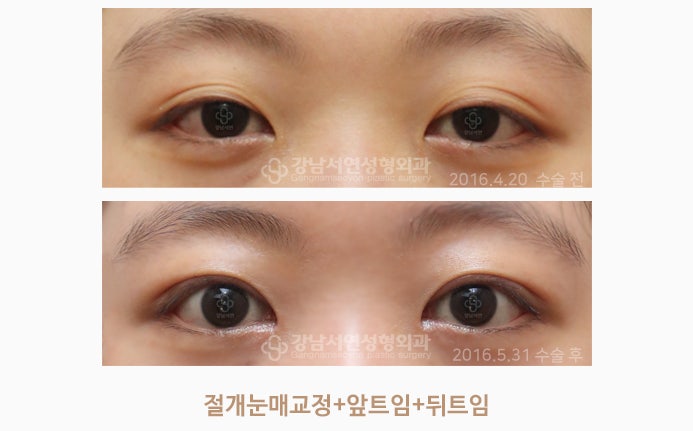 앞트임복원 / 앞트임재수술