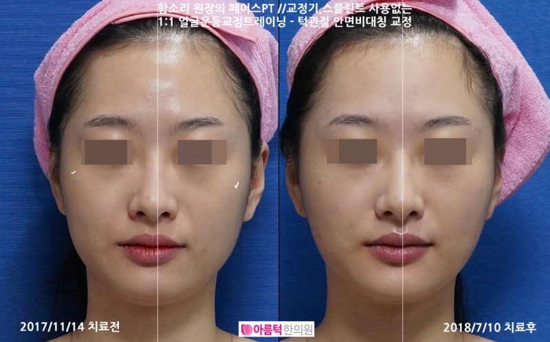 인천 얼굴 비대칭 안면 밸런스 되찾아 몸 바로 턱관절 개선