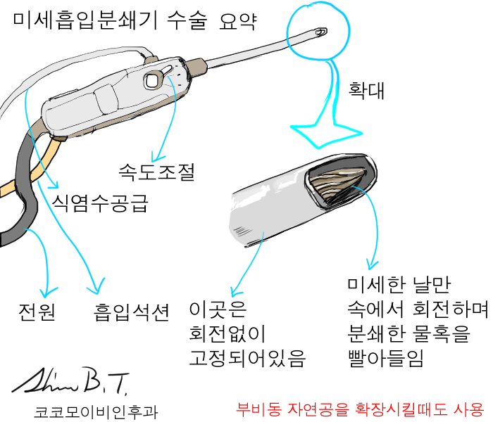  축농증수술의 핵심 원리와 코물혹수술에서 가장 중요한 부위와 수술방법