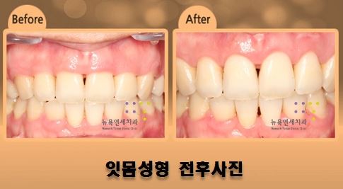  잇몸성형 수술 시간과 효과가 궁금하시죠?