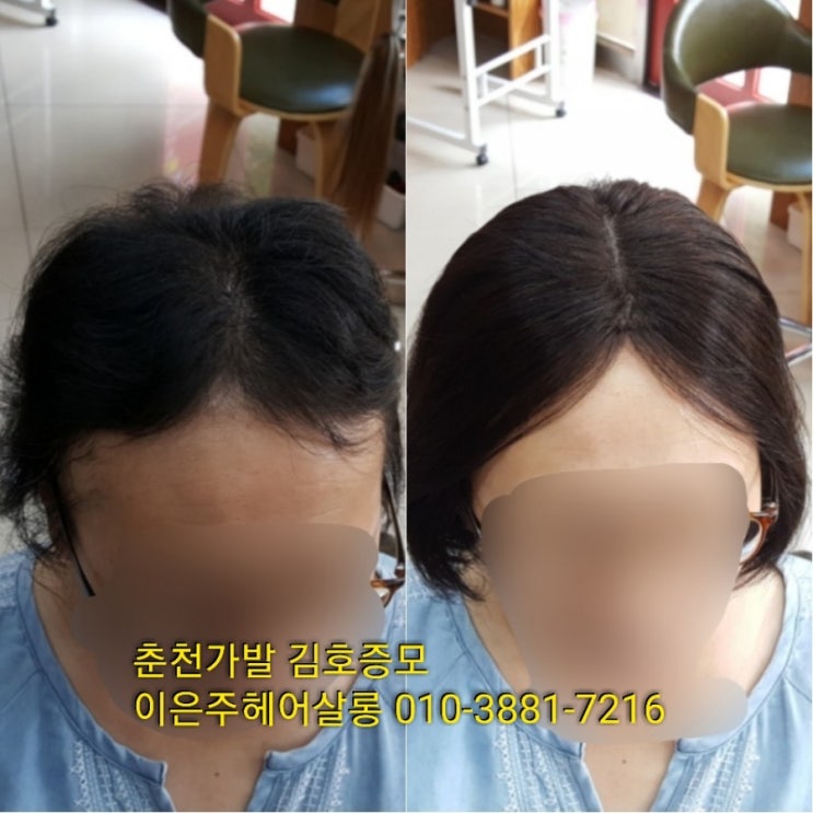  춘천가발 김호증모 다발성원형탈모고객님 여자반전두맞춤가발 피팅하는 날~^^
