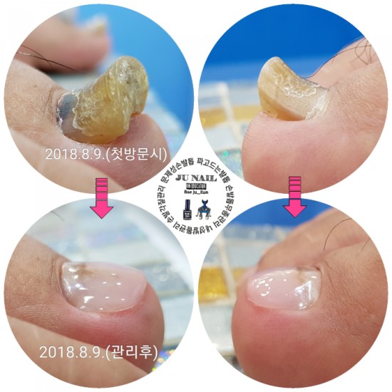 군대에서 시작된 발톱무좀/분당용인수원수지보정동백죽전동/주네일/두꺼워진무좀발톱