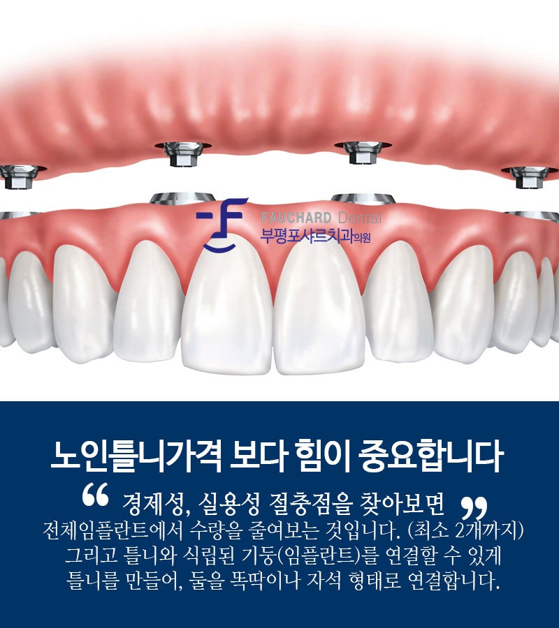 노인용 임플란트 틀니 가격을 비교해 보면