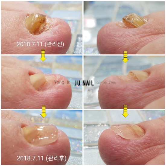 발톱이 빠진후 변형된발톱/분당용인수원수지보정동백죽전동/주네일/문제성발톱 발톱이 빠진후 변형된발톱/분당용인수원수지보정동백죽전동/주네일/문제성발톱