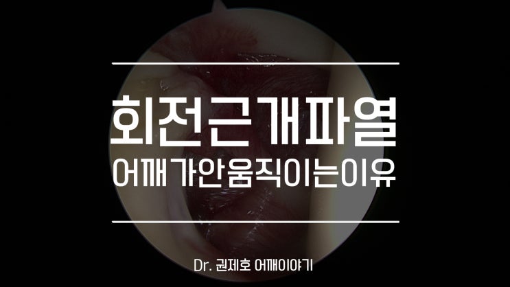  어깨회전근개파열수술 어깨가 안 움직이는 이유