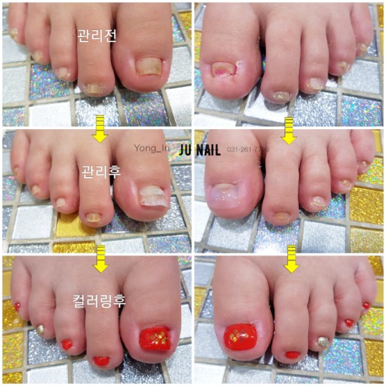 3번의수술후더아프고변형되고좁아진발톱/분당용인수원수지보정동백죽전동/주네일/파고드는발톱전문네일샵 3번의수술후더아프고변형되고좁아진발톱/분당용인수원수지보정동백죽전동/주네일/파고드는발톱전문네일샵
