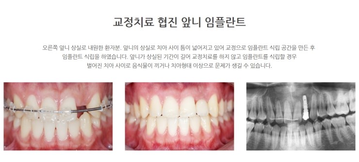 양천구 임플란트로 앞니 치료 시 주의사항 3