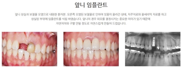 양천구 임플란트로 앞니 치료 시 주의사항 2