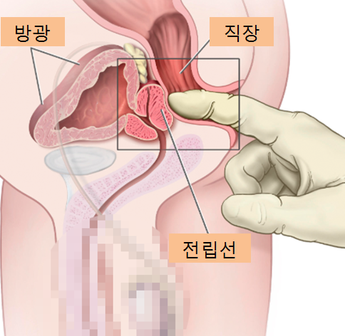  전립선 마사지의 진단적 역할과 치료적 효과