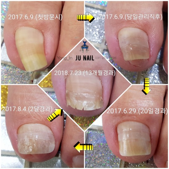 1년1개월후 아빠와딸/분당용인수원수지보정동백죽전동/주네일/파고드는무좀발톱전문네일샵 1년1개월후 아빠와딸/분당용인수원수지보정동백죽전동/주네일/파고드는무좀발톱전문네일샵
