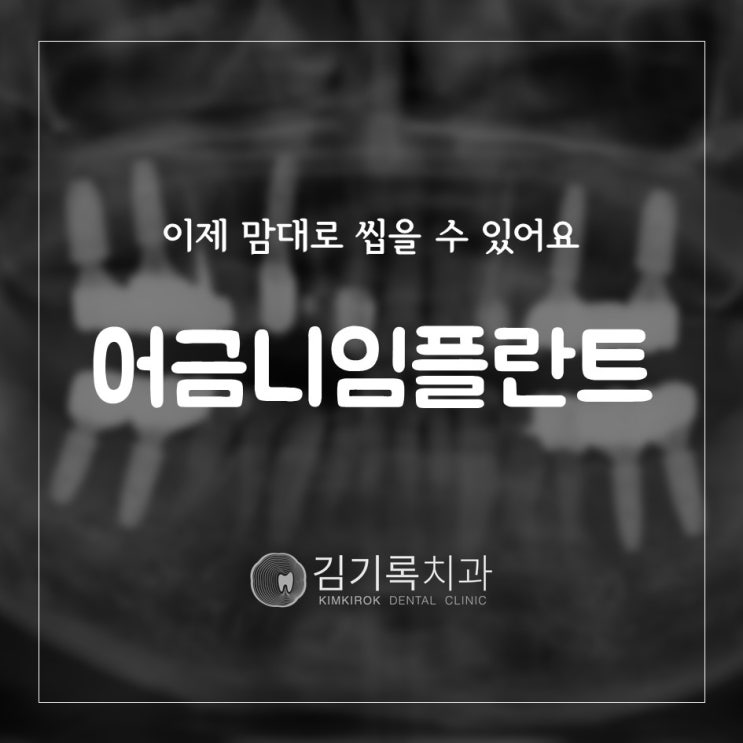 수원임플란트 치아가 없을 땐 어금니임플란트 네비게이션임플란트로!
