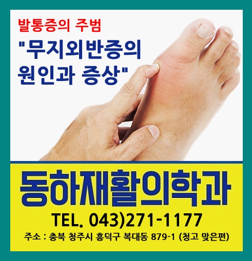 [청주무지외반증치료전문병원 동하재활의학과] 발통증의 주범 "무지외반증의 원인과 증상" ....