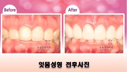  치과에서 잇몸성형 수술하고 보기 좋은 스마일라인으로 교정하기!