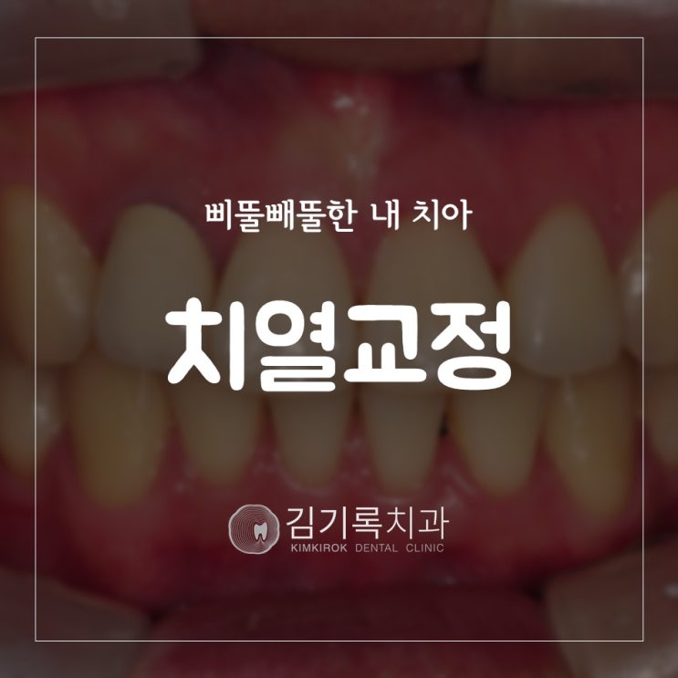 수원치아교정전문의 튀어나온 앞니와 삐뚤빼뚤 치열교정 총생교정 수원김기록치과