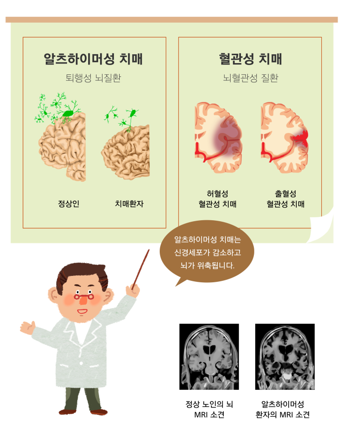 혈관성 치매 치료 포기하지 마세요!