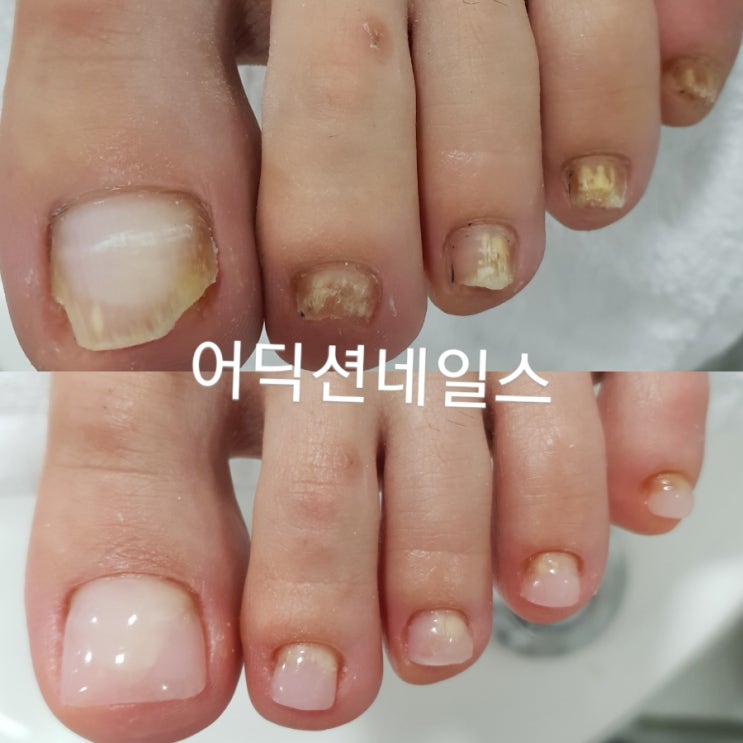  발톱무좀패디큐어