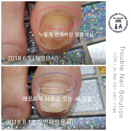 다시살아나오는발톱/분당용인수원수지보정동백죽전동/주네일/파고드는무좀발톱전문네일샵 다시살아나오는발톱/분당용인수원수지보정동백죽전동/주네일/파고드는무좀발톱전문네일샵