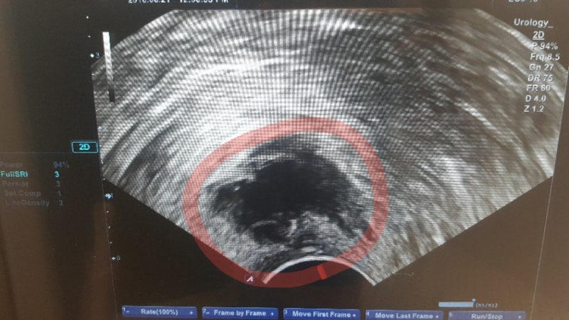 항문 농양 제거수술 진행과정 및 관리방법 (인천 항문외과 추천 차외과 에서 수술후기) 여의사도 있음!! : 네이버 블로그 항문 농양 제거수술 진행과정 및 관리방법 (인천 항문외과 추천 차외과 에서 수술후기) 여의사도 있음!! : 네이버 블로그