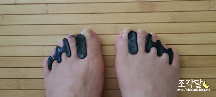  발가락변형, 무지외반증때문에 발가락교정기 착용했어요!