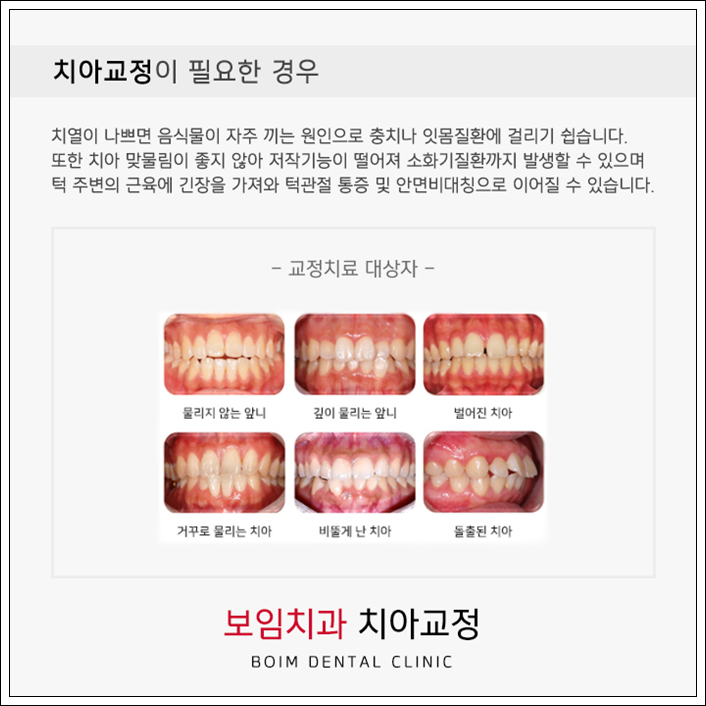 일산치아교정 필요한 경우와 기간부터 7