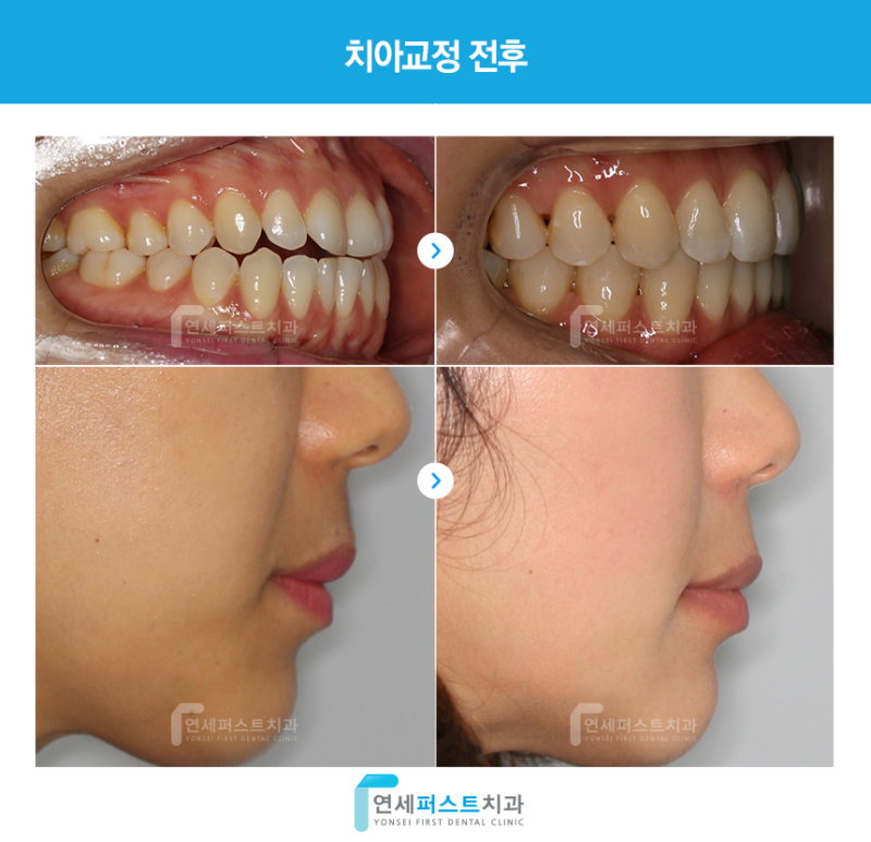 치아 변색 치료의 종류와 방법 비교 푸핑구치과병원