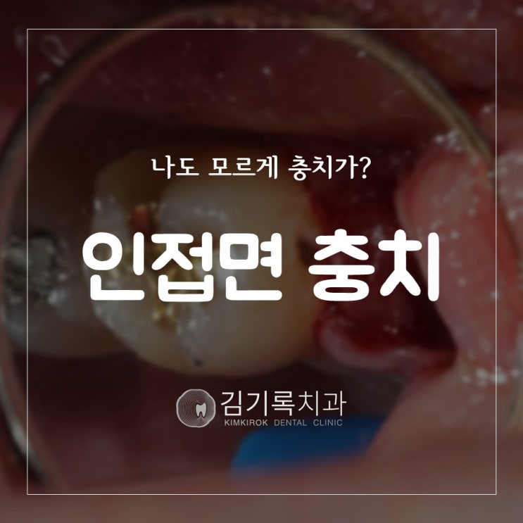 수원치과잘하는곳 치아 사이 충치 인접면 충치는 어떻게 치료할까요?
