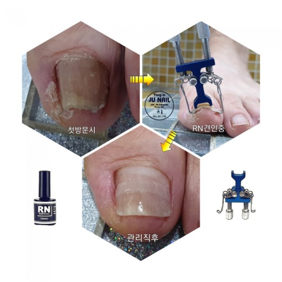 10년을넘게참아온아픈내성발톱/분당용인수원수지보정동백죽전동/주네일/파고드는발톱 10년을넘게참아온아픈내성발톱/분당용인수원수지보정동백죽전동/주네일/파고드는발톱