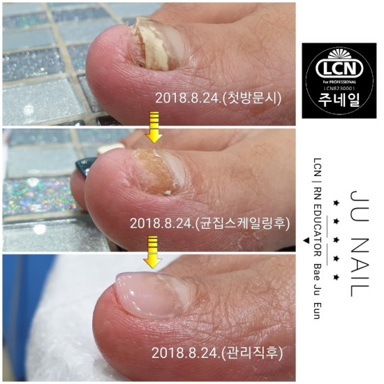 얼마나고민이면이천에서용인까지분당용인수원수지보정동백죽전동/주네일/두꺼워진무좀발톱