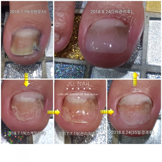 부끄러워내놓지못한발올여름세상밖으로/분당용인수원수지보정동백죽전동/주네일/파고드는발톱