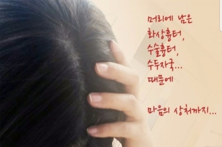  춘천가발 김호증모 흉터맞춤가발