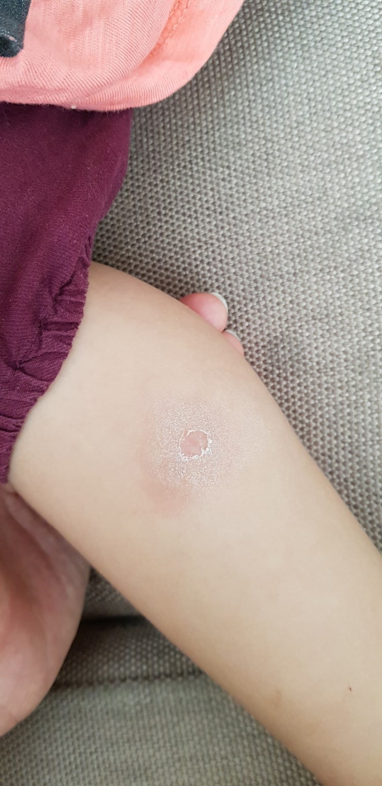  화상벌레 다녀가셨어요