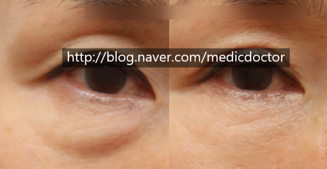 Under-eye Fat Repositioning