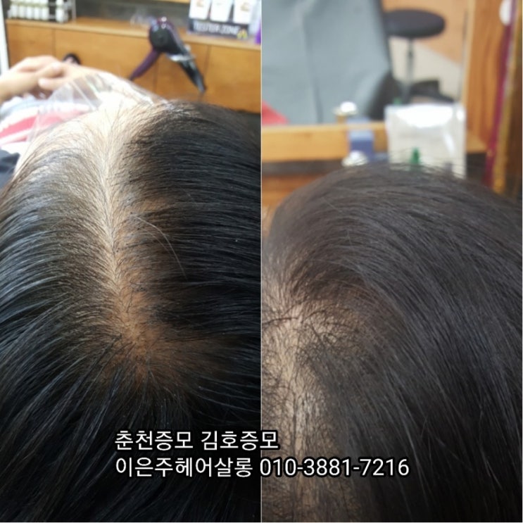  춘천증모 김호증모 일본식파워재사용증모술 리터치 하는날~