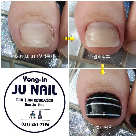 발톱너무짧게깎으면안돼요/분당용인수원수지보정동백죽전동/주네일/내향성발톱 발톱너무짧게깎으면안돼요/분당용인수원수지보정동백죽전동/주네일/내향성발톱