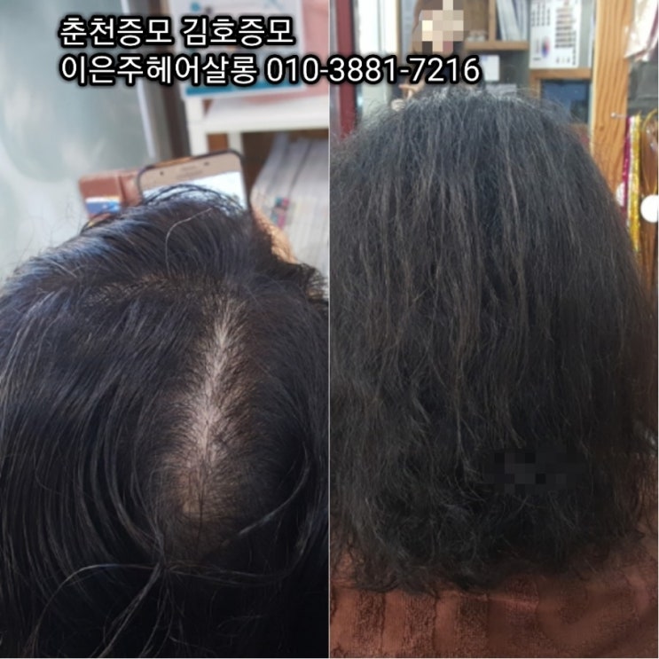  춘천증모 김호증모 앞머리 가르마 탑볼륨 정수리 숱보강 헤어증모로 다증모술과 보톡스증모술의 콜라보레이션~^^