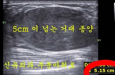 유방멍울 섬유선종 제거술(부분마취로)