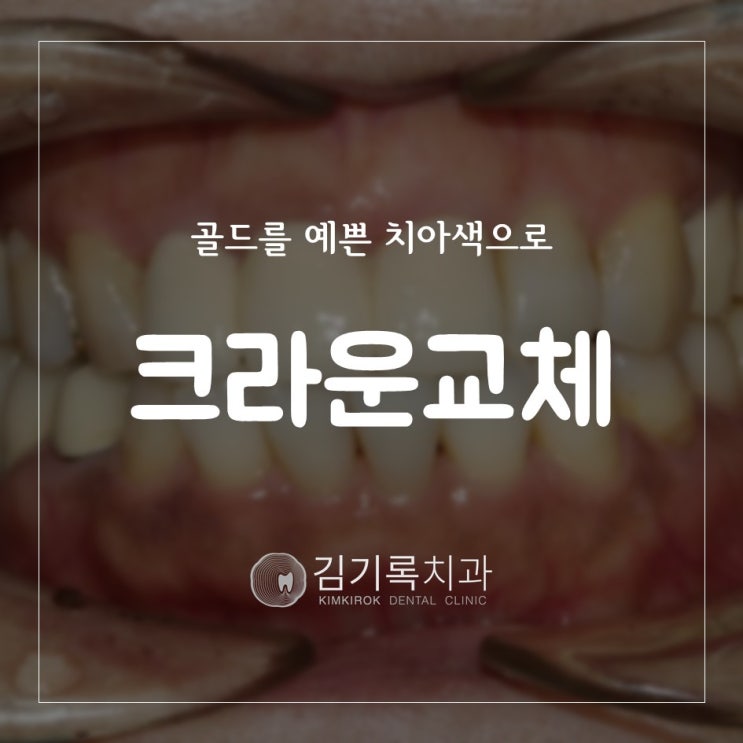 오스템임플란트이벤트 수원임플란트명의 임플란트 치료 도중 치과 변경 골드 크라운 지르코니아 변경