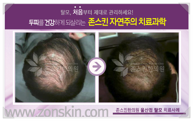 울산탈모치료, 소아탈모가 더 위험해요!