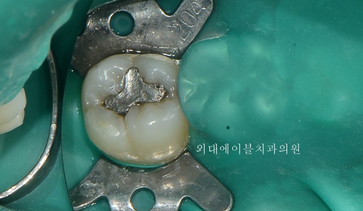 치아 레진, 몇가지 충치치료 케이스